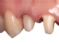 ファイバーコア