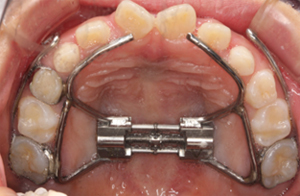 顎顔面矯正治療