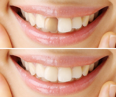 ウォーキングブリーチ